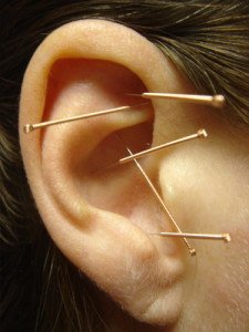 Image Pic auriculotherapy